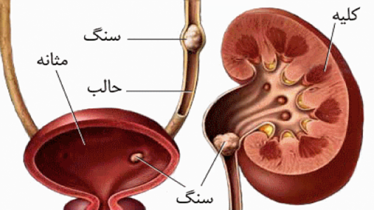 پیشگیری  از سنگ کلیه