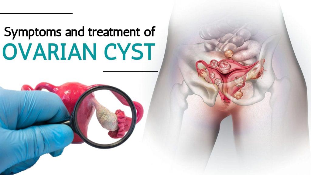 چه دارویی برای کیست تخمدان خوبه