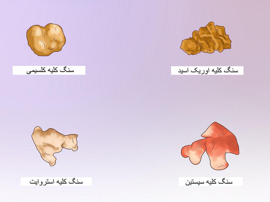 پیشگیری  از سنگ کلیه