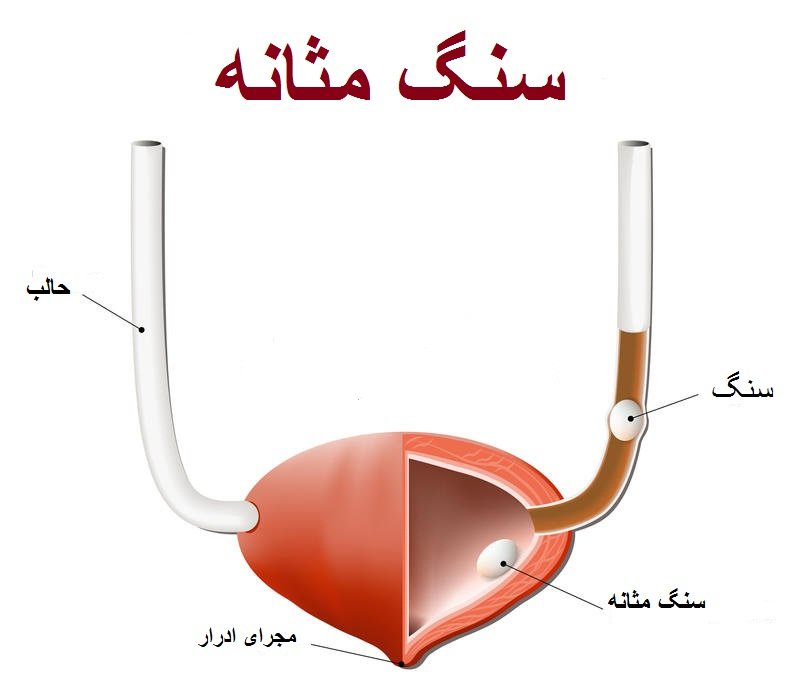 علل افرایش احتمال سنگ کلیه در زنان