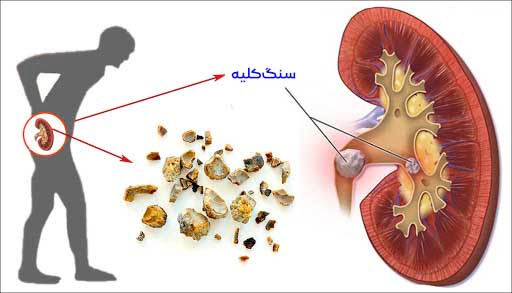 آیا سنگ کلیه خطرناک است؟